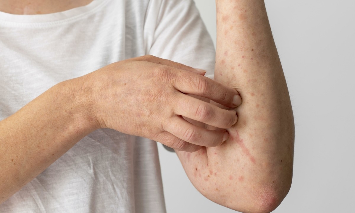 skin-allergy-reaction-person-s-8861-4656-1682788096-1687408874.jpg