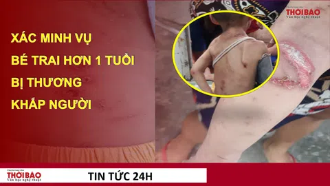 Xác minh vụ bé trai hơn 1 tuổi bị thương khắp người ở Hóc Môn