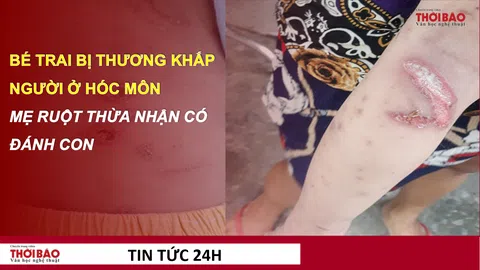 Vụ bé trai 2 tuổi nhập viện ở Hóc Môn: Mẹ ruột thừa nhận có đánh con