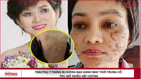 Thai phụ 7 tháng bị chồng bạo hành như thời trung cổ: Thu giữ vật chứng